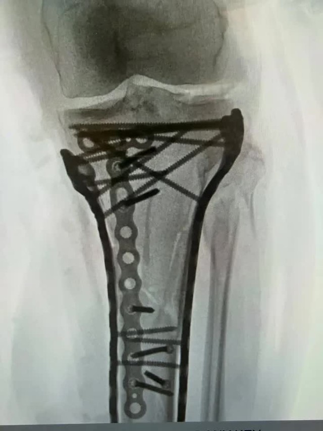 Xúc động lời nhắn Ronaldo gửi nữ thần trượt tuyết suýt phải cắt cụt chân sau tai nạn kinh hoàng ở Olympic - Ảnh 2.