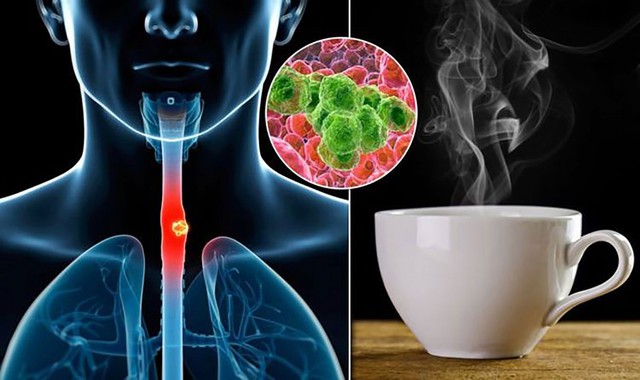 Loại nước "nuôi tế bào ung thư", uống mỗi ngày có thể tăng gấp 6 lần nguy cơ: Nhiều người Việt hay dùng- Ảnh 1.