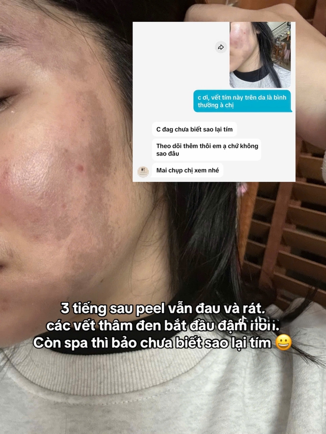 Cô gái “banh mặt” khi peel da ở spa: Suýt mất Tết, tốn 10 lần tiền chữa nỗi đau- Ảnh 6.