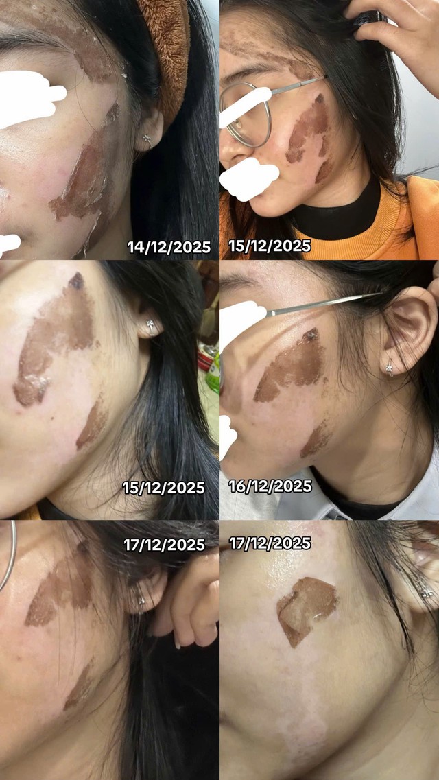 Cô gái “banh mặt” khi peel da ở spa: Suýt mất Tết, tốn 10 lần tiền chữa nỗi đau- Ảnh 3.