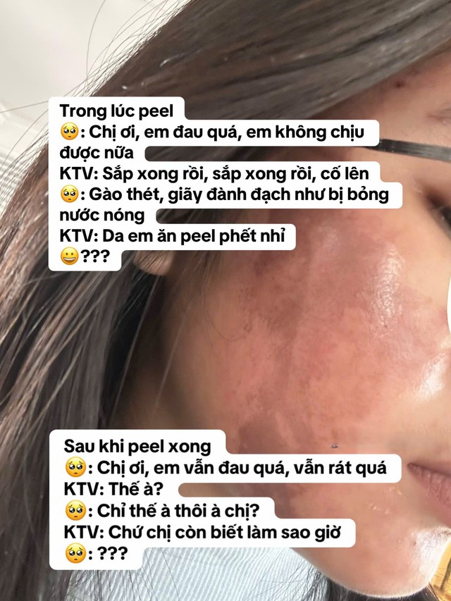 Cô gái “banh mặt” khi peel da ở spa: Suýt mất Tết, tốn 10 lần tiền chữa nỗi đau- Ảnh 4.