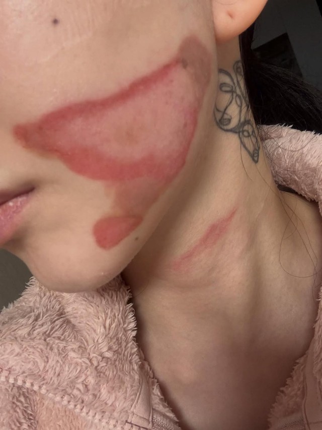 Nữ thần sắc đẹp showbiz bị bỏng mặt nghiêm trọng hậu thẩm mỹ, nhìn tình hình hiện tại mà xót thay- Ảnh 1.