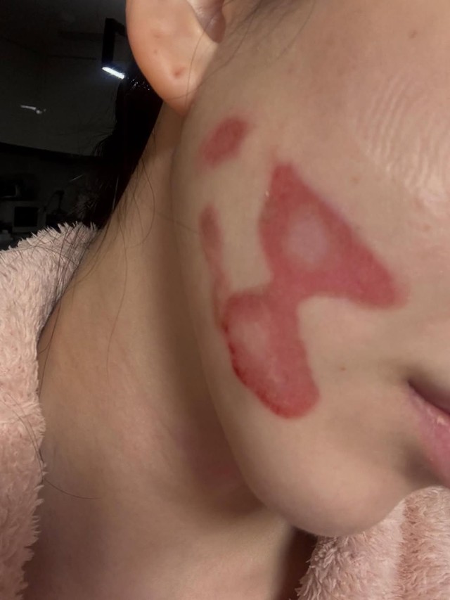 Nữ thần sắc đẹp showbiz bị bỏng mặt nghiêm trọng hậu thẩm mỹ, nhìn tình hình hiện tại mà xót thay- Ảnh 2.