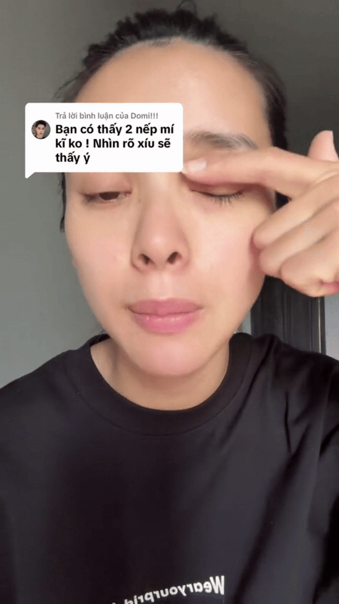 Mỹ nhân vừa vượt mặt Tiểu Vy “thừa nhận” phẫu thuật thẩm mỹ, chỉ đích danh bác sĩ của mình- Ảnh 7. Mỹ nhân vừa vượt mặt Tiểu Vy “thừa nhận” phẫu thuật thẩm mỹ, chỉ đích danh bác sĩ của mình- Ảnh 7.