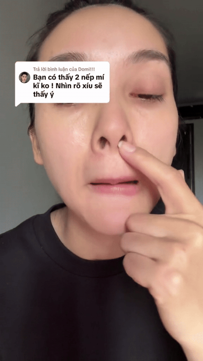 Mỹ nhân vừa vượt mặt Tiểu Vy “thừa nhận” phẫu thuật thẩm mỹ, chỉ đích danh bác sĩ của mình- Ảnh 8. Mỹ nhân vừa vượt mặt Tiểu Vy “thừa nhận” phẫu thuật thẩm mỹ, chỉ đích danh bác sĩ của mình- Ảnh 8.