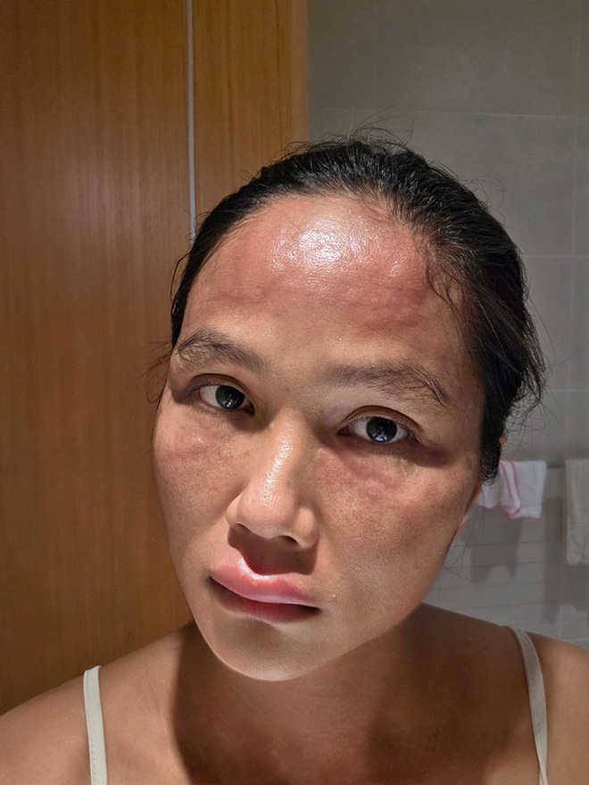 Hoa hậu H’Hen Niê khiến nhiều mẹ bỉm vừa xót xa vừa đồng cảm khi chia sẻ hình ảnh bị nổi mề đay sau sinh- Ảnh 2.