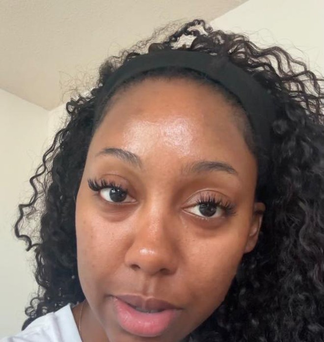 Quá sợ tuổi già, ngày càng nhiều cô gái U30 làm các loại phẫu thuật thẩm mỹ trước đây chỉ dành cho U60- Ảnh 11. Quá sợ tuổi già, ngày càng nhiều cô gái U30 làm các loại phẫu thuật thẩm mỹ trước đây chỉ dành cho U60- Ảnh 11.