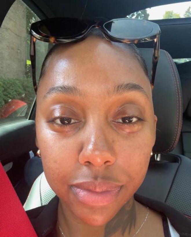 Quá sợ tuổi già, ngày càng nhiều cô gái U30 làm các loại phẫu thuật thẩm mỹ trước đây chỉ dành cho U60- Ảnh 12. Quá sợ tuổi già, ngày càng nhiều cô gái U30 làm các loại phẫu thuật thẩm mỹ trước đây chỉ dành cho U60- Ảnh 12.