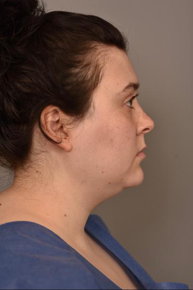 Quá sợ tuổi già, ngày càng nhiều cô gái U30 làm các loại phẫu thuật thẩm mỹ trước đây chỉ dành cho U60- Ảnh 9. Quá sợ tuổi già, ngày càng nhiều cô gái U30 làm các loại phẫu thuật thẩm mỹ trước đây chỉ dành cho U60- Ảnh 9.