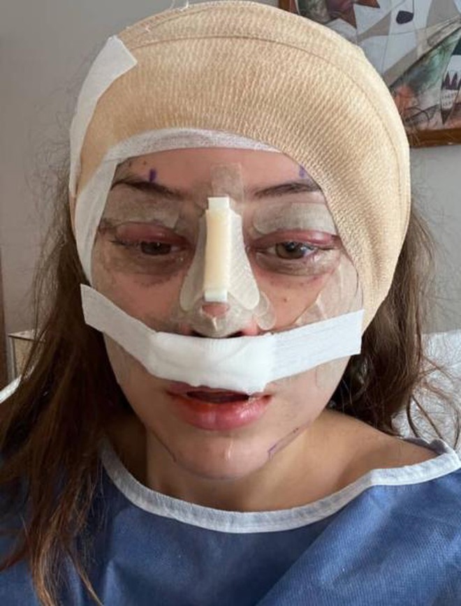 Quá sợ tuổi già, ngày càng nhiều cô gái U30 làm các loại phẫu thuật thẩm mỹ trước đây chỉ dành cho U60- Ảnh 3. Quá sợ tuổi già, ngày càng nhiều cô gái U30 làm các loại phẫu thuật thẩm mỹ trước đây chỉ dành cho U60- Ảnh 3.