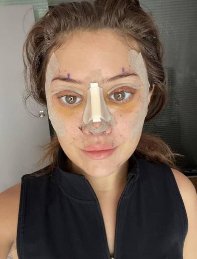 Quá sợ tuổi già, ngày càng nhiều cô gái U30 làm các loại phẫu thuật thẩm mỹ trước đây chỉ dành cho U60- Ảnh 4. Quá sợ tuổi già, ngày càng nhiều cô gái U30 làm các loại phẫu thuật thẩm mỹ trước đây chỉ dành cho U60- Ảnh 4.