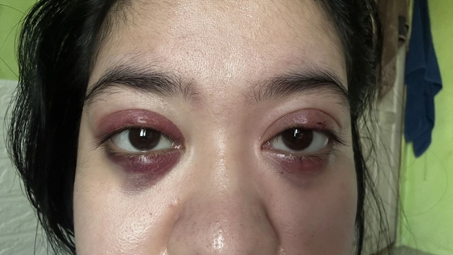 Phấn mắt PINKFLASH dính bê bối lớn: Người dùng bị lẹo mắt hàng loạt, hãng tiêu huỷ, đền tiền gấp đôi- Ảnh 5.