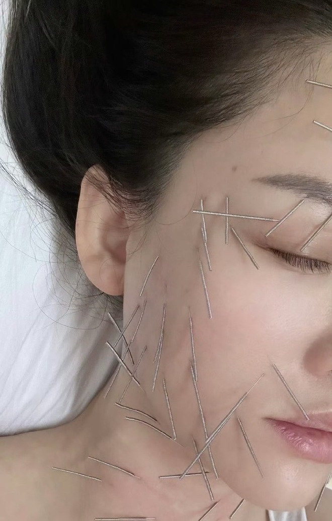 Sốc nặng hình ảnh Trần Kiều Ân cắm hàng trăm chiếc kim khắp cơ thể, làm đẹp mà chấp nhận đau đớn không tưởng!- Ảnh 1.