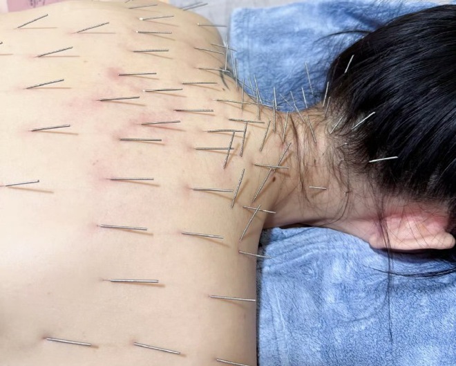 Sốc nặng hình ảnh Trần Kiều Ân cắm hàng trăm chiếc kim khắp cơ thể, làm đẹp mà chấp nhận đau đớn không tưởng!- Ảnh 4.