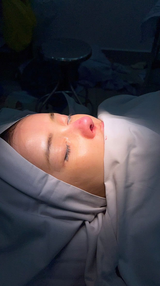 Ngân 98 bị biến chứng nhiễm trùng nặng sau 11 lần phẫu thuật thẩm mỹ- Ảnh 6. Ngân 98 bị biến chứng nhiễm trùng nặng sau 11 lần phẫu thuật thẩm mỹ- Ảnh 6.