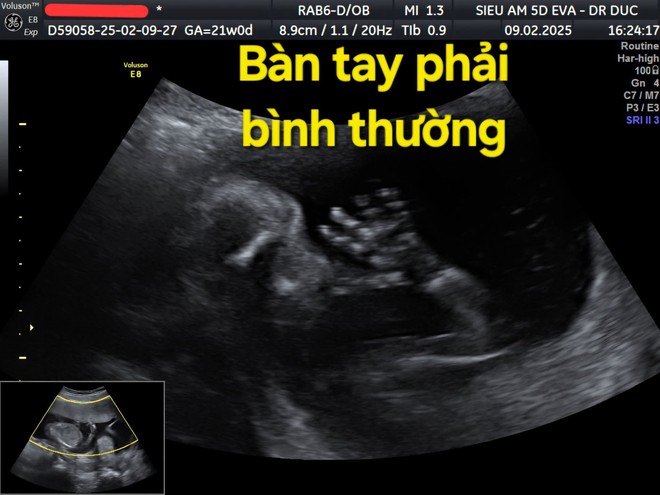 Thai nhi 21 tuần bị cắt cụt các ngón tay vì một thứ "sắc hơn dao" ngay trong bụng mẹ: Nguy hiểm nhưng khó phát- Ảnh 1.