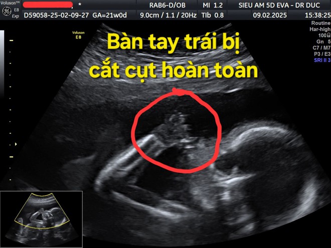 Thai nhi 21 tuần bị cắt cụt các ngón tay vì một thứ "sắc hơn dao" ngay trong bụng mẹ: Nguy hiểm nhưng khó phát- Ảnh 2.