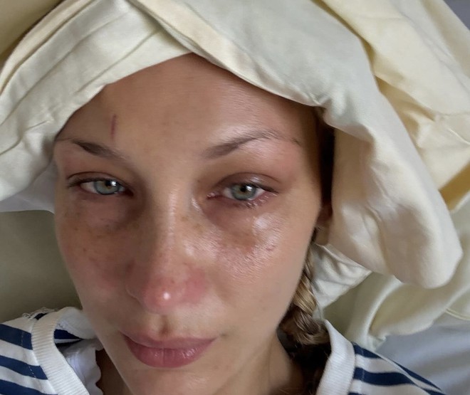Em gái siêu mẫu của Gigi Hadid vật vã đau đớn vì căn bệnh nguy hiểm liên quan đến não- Ảnh 5.