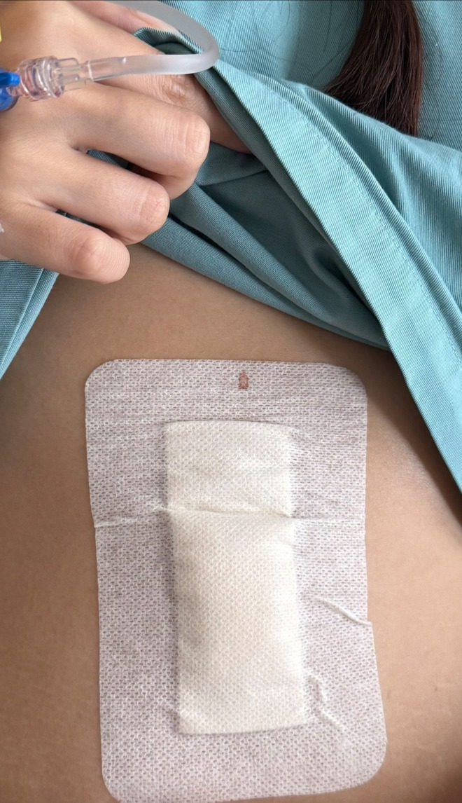 Đi ăn ốc, cô gái nuốt cả chiếc kim băng đang mở vào bụng, phải mổ cấp cứu 6 tiếng, tốn 70 triệu- Ảnh 3.