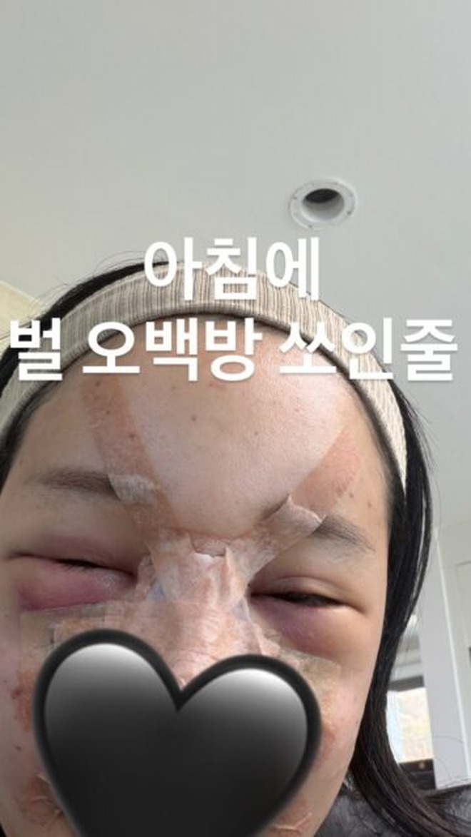 Trùng tu nhan sắc để ăn Tết, 1 sao nữ mặt mũi biến dạng, sưng phồng như bị "500 con ong đốt"- Ảnh 2.