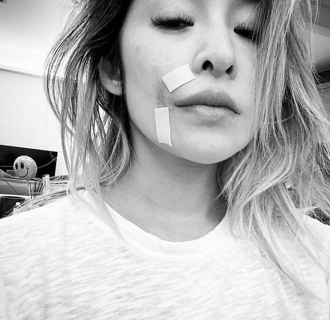 Nữ ca sĩ bị tai nạn đến hủy dung: Vết thương hoại tử 2 tháng, giờ gây sốc với "gương mặt rắn" méo mó- Ảnh 2.