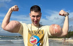 Tiêm chất làm phồng cơ bắp đến dị dạng, "quái vật thể hình" đối diện nguy cơ phải cắt cụt hai cánh tay?