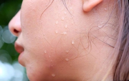 Sinh viên Đại học Bách khoa năm cuối bị basedow nhiều năm, bác sĩ hỏi vẫn không biết mình mắc bệnh gì