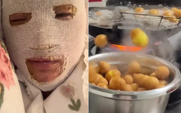 Cô gái suýt biến dạng khuôn mặt khi nấu ăn, cảnh báo 3 thực phẩm dễ "phát nổ" cần chú ý