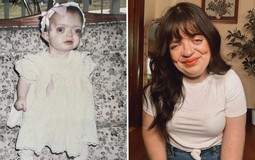 Tôi đã che giấu khuôn mặt suốt nhiều năm, nhưng giờ tôi tự hào chấp nhận vẻ khác biệt của chính mình