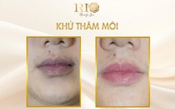 Hết thâm môi nhanh nhờ công nghệ khử thâm môi mới