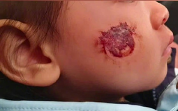 Bé gái 3 tuổi bị bỏng rộp cả mặt vì “miếng dán đồ chơi”: Nhiều đồ chơi hot trên mạng tuyệt đối không mua