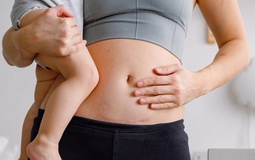 Vẫn biết phần lớn là do cơ địa, thế nhưng làm sao để vết sẹo mổ đẻ "đẹp" nhất có thể?