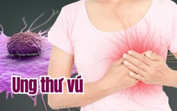 Phụ nữ sau tuổi 30 "sở hữu" 2 đặc điểm này có nguy cơ bị ung thư vú cao gấp 3 lần