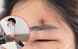 Tự nặn mụn ở trán, người phụ nữ U40 phải trả giá đắt