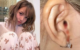 "Máu nhỏ giọt từ tai tôi", tiết lộ của Lisa (BlackPink) khiến nhiều người lo lắng: Chuyên gia chỉ ra nguyên nhân