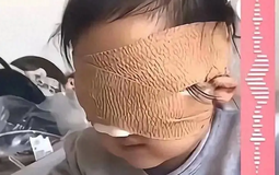 Bé gái 6 tuổi mất cả 2 mắt vì thứ nhiều bố mẹ vẫn cho con chơi mỗi ngày
