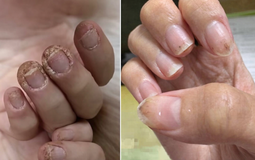 Cô gái 28 tuổi móng tay "mục như gỗ", chạm nhẹ là rụng cả mảng vì sở thích "vạn người mê" của các chị em