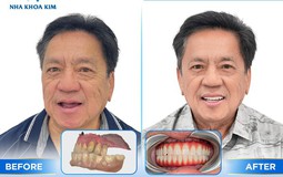 Vì sao Implant công nghệ cao trở thành lựa chọn đầu tư thông minh cho nụ cười người Việt?