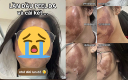 Cô gái “banh mặt” khi peel da ở spa: Suýt mất Tết, tốn 10 lần tiền chữa nỗi đau