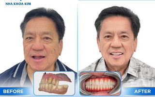 Vì sao Implant công nghệ cao trở thành lựa chọn đầu tư thông minh cho nụ cười người Việt?