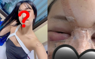 Trùng tu nhan sắc để ăn Tết, 1 sao nữ mặt mũi biến dạng, sưng phồng như bị "500 con ong đốt"