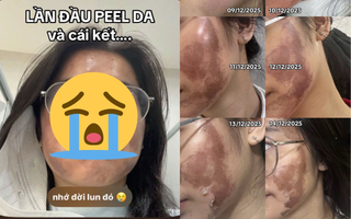Cô gái “banh mặt” khi peel da ở spa: Suýt mất Tết, tốn 10 lần tiền chữa nỗi đau