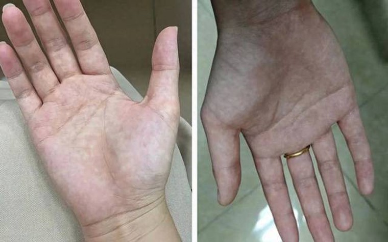 Bàn tay là tín hiệu cảnh báo sức khỏe: 1 thay đổi có thể cho thấy bệnh tiểu đường hoặc xơ gan